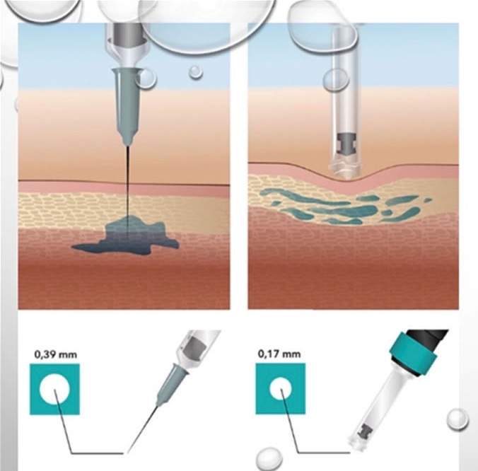 Schematische Darstellung Iri-Pen